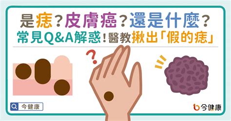 凸痣長毛|痣長毛=皮膚癌？醫解惑